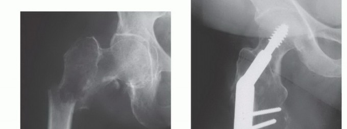 Illustration 4 for Plain Radiograph Showing MBD: Surgical Planning to Prevent Failures