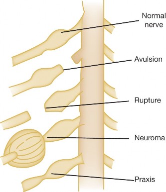 Diagnosing Brachial Plexus Birth: Newborn Arm Paralysis Case