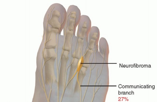 Morton Neuroma: Treating Pain in the Common Digital Nerve
