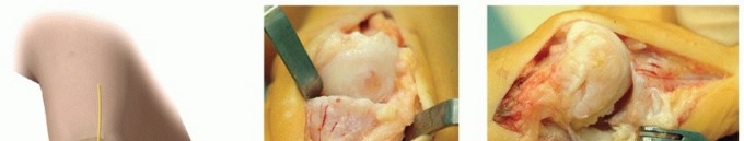 Illustration 3 for Mastering Extensive Plantar Release for Hallux Rigidus