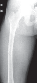 Titanium Elastic Nails: Effective Femoral Fracture Nailing