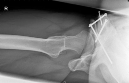 Illustration 9 for Bernese Periacetabular Osteotomy: Your Definitive Case Title Bernese