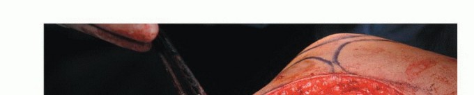 صورة طبية: استئصال أورام الشظية: دليل شامل للعلاج الحديث والحفاظ على الأطراف مع الأستاذ الدكتور محمد هطيف