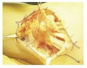 Tendon Transfers Used for Treatment of Rheumatoid Disorders