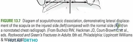 Illustration of scapulothoracic dissociation scapulothoracic - Dr. Mohammed Hutaif