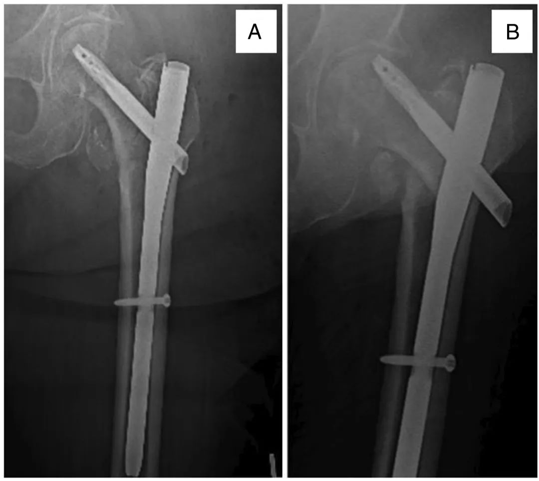 Intertrochanteric Fracture Fixation Failure: A Deep Dive into Lag Screw Exchange & Cement Augmentation