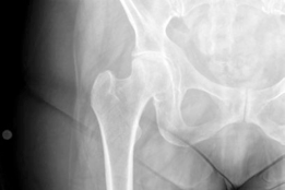 Analyzing a Hybrid Primary Hip Arthroplasty Patient Case