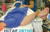 متى أعود لحياتي الطبيعية؟ كم يستغرق شفاء كسر اليد؟