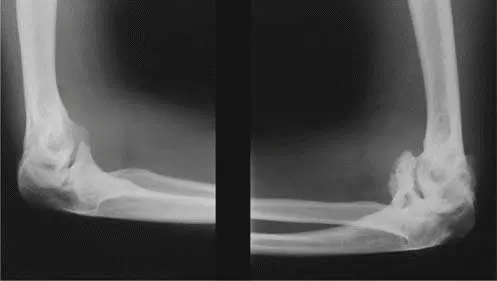 صورة توضيحية لـ خلل التنسج المشاشي المتعدد والتهاب مفصل الورك الشديد الأسباب الأعراض العلاج في صنعاء