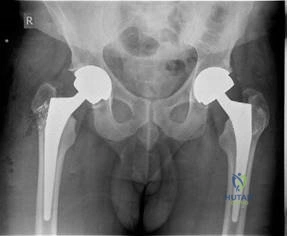 Illustration 4 for Is Your Femoral Head Affected? Understanding Hip Osteoarthritis