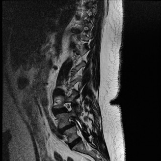 Illustration 19 for Spine Cases: Consider the Patient for Accurate Diagnosis