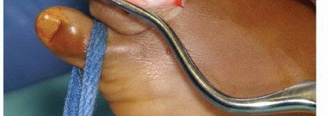 صورة طبية: تجنب الجراحة الكبرى: علاج أورام العظام بالنيتروجين السائل بتقنية الصب المباشر