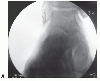 Lateral Ankle Repair: Maximize Stability with Interference Screw Fixation
