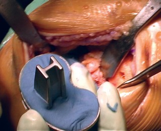 Illustration 33 for Cemented TKA Figure: Your Visual Guide to Surgical Success