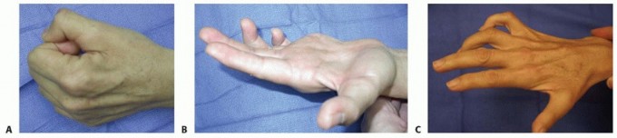 Illustration of third web space - Dr. Mohammed Hutaif