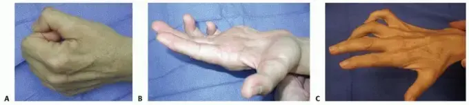 صورة توضيحية لـ شلل العصب الزندي: دليل شامل للمرضى حول الأسباب، الأعراض، وطرق العلاج المتطورة في اليمن والخليج