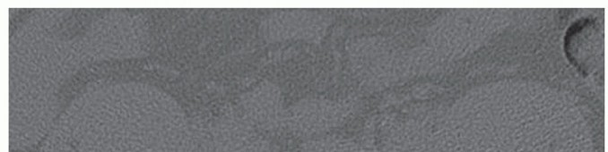 Avoid & Repair: Management of Intraoperative CSF Leaks