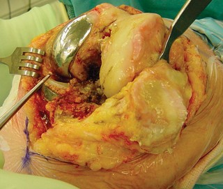 Illustration 18 for Revision of Failed UKA: Your Guide to Successful Treatment