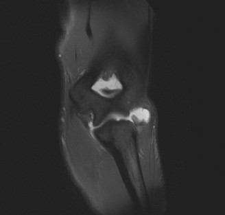 Illustration of collateral ligament instability - Dr. Mohammed Hutaif