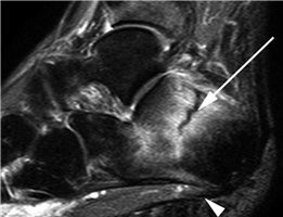 Illustration 36 for First Metatarsal Surgery: Expert Solutions for Foot & Ankle Pain