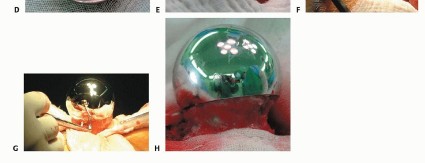 صورة طبية: ترميم مفصل الورك: الحل الأمثل للحفاظ على عظم رأس الفخذ في صنعاء مع الدكتور محمد هطيف