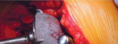 صورة طبية: تقنية الجذع القصير لاستبدال مفصل الورك الكلي: نهج الأستاذ الدكتور محمد هطيف لتدخل جراحي أقل ونتائج أفضل