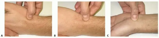 صورة توضيحية لـ علاج متقدم لعدم التئام كسر العظم الزورقي بالرسغ: الترقيع العظمي الوعائي مع الأستاذ الدكتور محمد هطيف