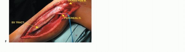 صورة طبية: استئصال أورام الشظية: دليل شامل للعلاج الحديث والحفاظ على الأطراف مع الأستاذ الدكتور محمد هطيف