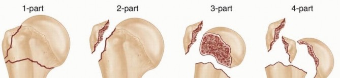 Mastering O.R.I.F. for Displaced Proximal Humeral Fractures