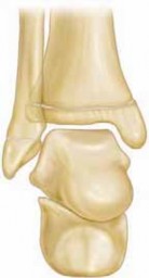 Illustration of hemiepiphysiodesis for ankle - Dr. Mohammed Hutaif