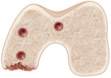 Illustration 25 for Revision of Failed UKA: Your Guide to Successful Treatment