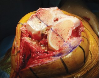 Illustration 3 for Posterior Cruciate Ligament-Retaining TKA: Navigating Pitfalls