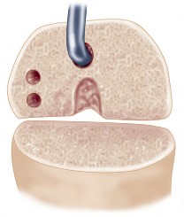 Illustration 28 for Revision of Failed UKA: Your Guide to Successful Treatment