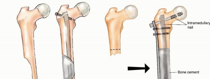 Illustration 16 for Plain Radiograph Showing MBD: Surgical Planning to Prevent Failures