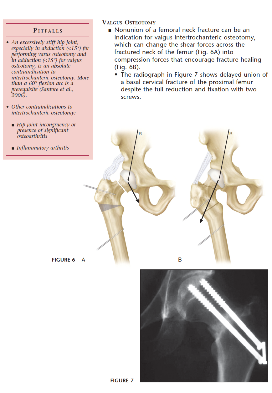 Illustration 4 for Intertrochanteric Femoral Osteotomy: Indications for Hip Preservation