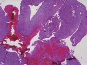 Understanding Benign Bone Cysts: Causes, Symptoms & Treatments