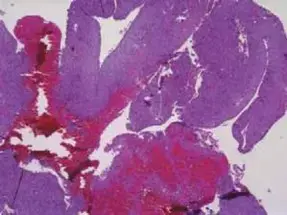 أكياس العظام الحميدة: دليل شامل للمرضى في اليمن والخليج العربي