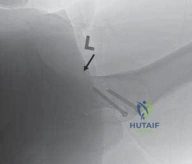 Execution of the Trochanteric Osteotomy