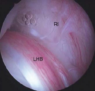 Illustration of elbow cases biceps - Dr. Mohammed Hutaif