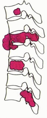 Illustration 7 for Total En Bloc Spondylectomy: Complete Resection for Spinal Tumors