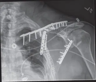 صورة توضيحية لـ كسور لوح الكتف: دليلك الشامل للتعافي الفعال مع الأستاذ الدكتور محمد هطيف