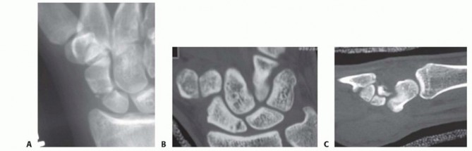 Open Reduction and Internal Fixation of Scaphoid Fractures
