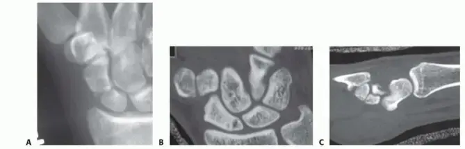 صورة توضيحية لـ كسر عظم الزورق في الرسغ: دليلك الشامل للتشخيص، العلاج، والتعافي مع الأستاذ الدكتور محمد هطيف