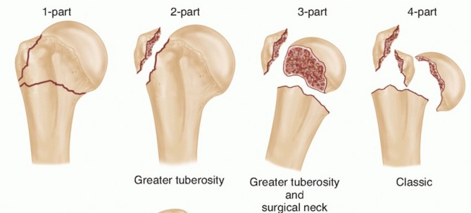 Optimizing Fixation of Proximal Humerus Fractures: A Guide