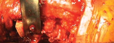 Illustration 19 for Unlock Movement: Arthroplasty for Bony Ankylosis Solutions