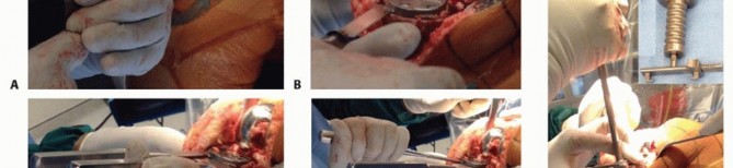 Illustration 7 for Removal of Well-fixed Components: Safe Techniques for Revision TKA