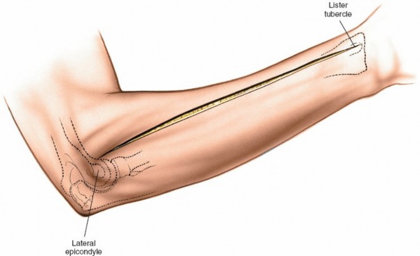 Illustration 58 for Mastering Approaches to the Upper Third of the Radius