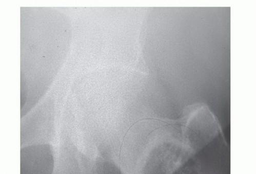 Illustration 9 for Plain Radiograph Showing MBD: Surgical Planning to Prevent Failures