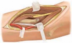 Mastering Percutaneous & Open Reduction for Radial Head & Neck Fractures