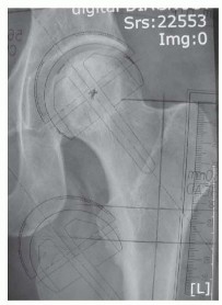 Hip Resurfacing: The Bone-Sparing Solution around the Femoral Head